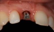 Зубний імплантат крок за кроком