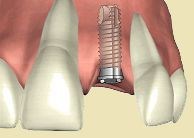 Зубний імплантат крок за кроком