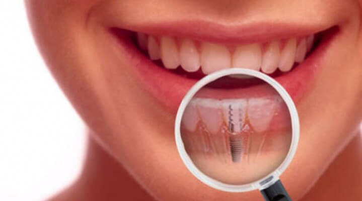 Имплантация зуба - что нужно знать