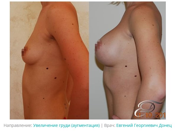 до и после увеличение груди