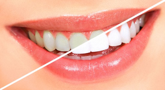 Причины отбелить зубы