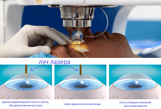 Лазерная коррекция зрения