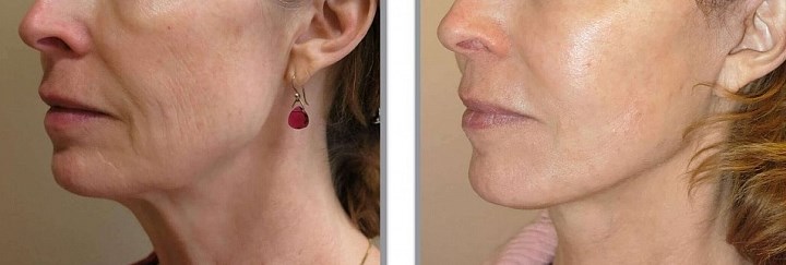 Липофилинг лица фото до и после