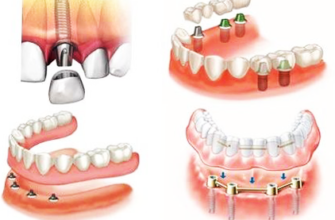 Протезирование зубов: Эффективные методы и современные технологии