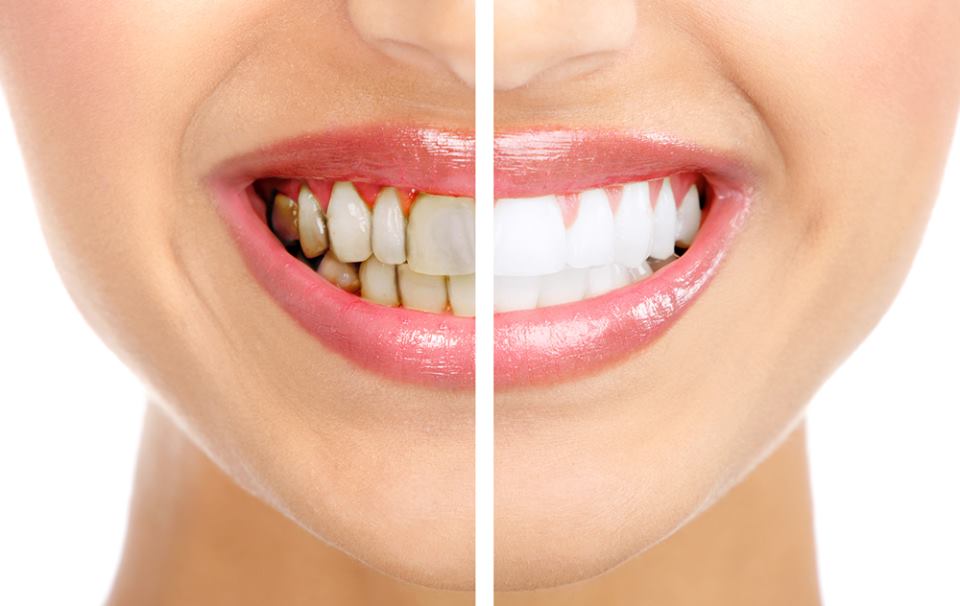 Стоит ли проводить отбеливание зубов?